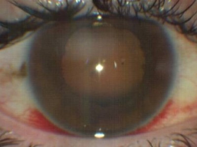 Spaltlampenfoto mit florider Iridozyklitis