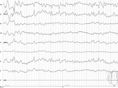 EEG des Neugeborenen