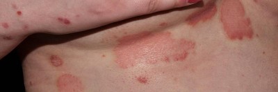 Psoriasis "flare up" in der Schwangerschaft