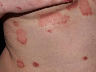 Psoriasis "flare up" in der Schwangerschaft