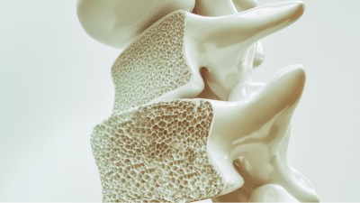 3D render of osteoporosis of the spine
