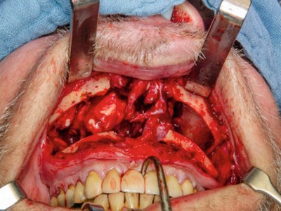 Intraoperativer Befund eines Patienten mit einem Osteom der Nasenhaupt- und Nasennebenhöhle nach temporärer Le-Fort-IOsteotomie