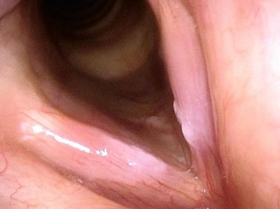 Typischer Biofilm mit flächiger oberflächlicher weißlicher Auflagerung