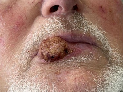 Plattenepithelkarzinom an Lippe
