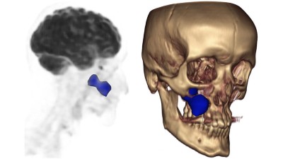 PET/CT Schädel: im Bereich des Sinus maxillaris rechts blau eingefärbte Raumforderung mit intensiver FDG-Avidität und ausgedehnter ossärer Destruktion der Wand des Sinus maxillaris bis in den Processus pterygoideus und die Orbitawand rechts