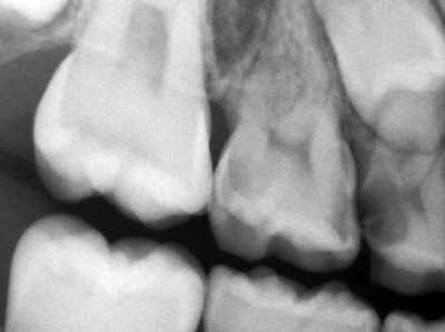 Bissflügelröntgenaufnahme, profunde kariöse Läsionen am Zahn 55 sowie Caries profunda mit Pulpabeteiligung am Zahn 54