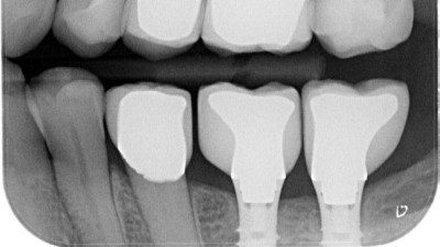 Einzelröntgenaufnahme: regio 36 und 37 wurden 2 Straumann-Implantate RN 4,1 mit der Länge 10 mm gesetzt