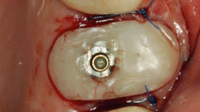 Eingesetztes Individuelles Healing Abutment und Weichgewebsstabilisierung. Das Abutment dichtet die Alveole vollständig ab.
