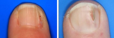 Onychopapillom bei zwei Patienten