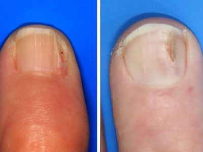 Onychopapillom bei zwei Patienten