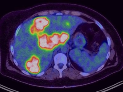Onkologie-PET mit Low-dose-CT im Sagittalschnitt durch die Leber