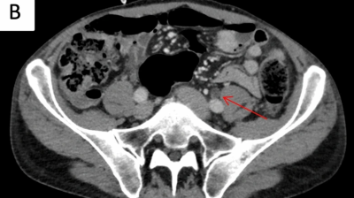 CT scan of seminoma patient with carboplatin-induced hematuria