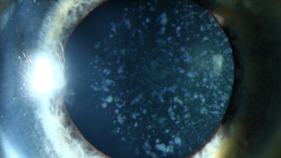 Aus dem Beitrag: Cataracta coerulea von Britz, L., Auffarth, G.U. & Khoramnia, R. Ophthalmologie 121, 525 (2024). 