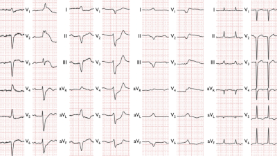ECG of patients with ICI-related fulminant myocarditis