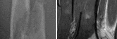  pathologische distale Femurfraktur