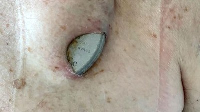 Patient mit perforierter ICD-Tasche