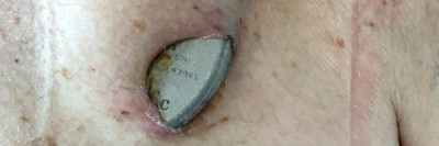 Patient mit perforierter ICD-Tasche