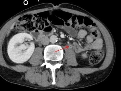 Ureterale Ektasie