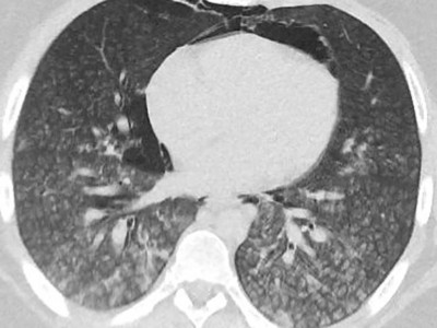 Akutes Atemnotsyndrom (ARDS)