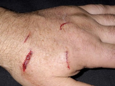 Hand mit Hundebiss
