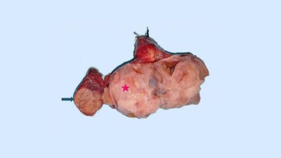 Total thyroidectomy specimen showing a solitary fibrous tumor and a papillary thyroid carcinoma