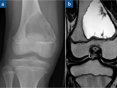 aneurysmatische Knochenzyste im Bereich des rechten distalen Femurs