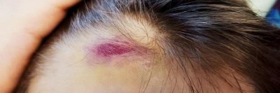 Hämatom an der Stirn des 9-Jährigen