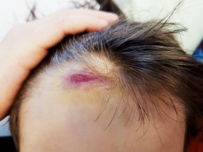 Hämatom an der Stirn des 9-Jährigen
