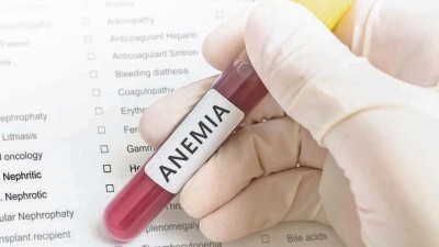Anemia