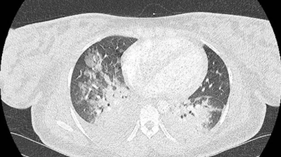  CT-Pulmonalisangiographie zeigt Alveoläres Lungenödem