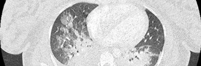  CT-Pulmonalisangiographie zeigt Alveoläres Lungenödem