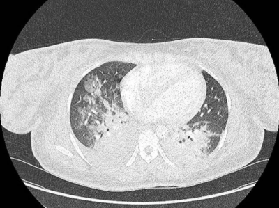  CT-Pulmonalisangiographie zeigt Alveoläres Lungenödem