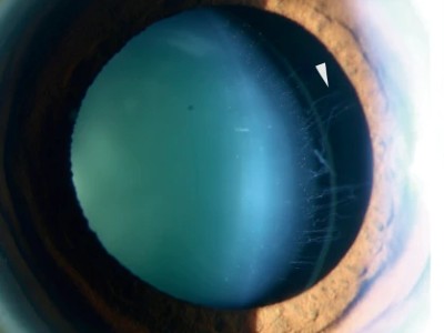 Subluxatio lentis bei Marfan-Syndrom