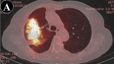 Radiological findings of patient with ICI-related pneumonitis