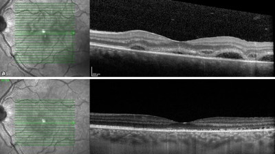 Uveitis bei Vogt-Koyanagi-Harada Syndrom
