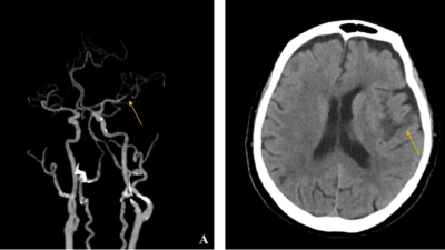Cerebral arteriography and brain CT showing blocked cerebral artery and cerebral ischemia