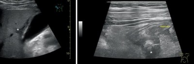 Appendizitis mit Perforation