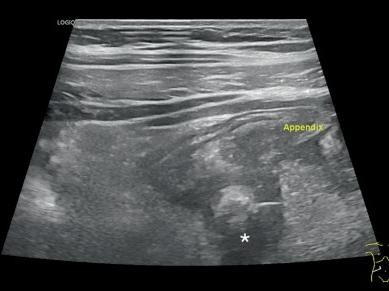 Appendizitis mit Perforation