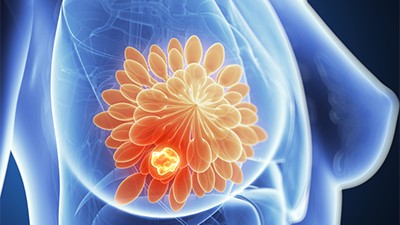 Breast Cancer