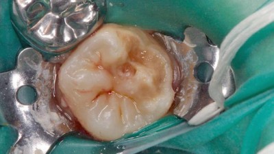 Molar eines 7-jährigen mit Molaren-Incisiven-Hypomineralisation im Kofferdamm