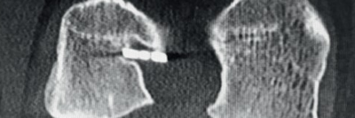 postoperative Computertomographie nach Ersatz des vorderen Kreuzbands 