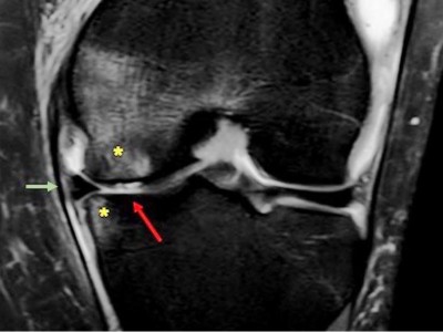 MRT bei medialseitiger Gonarthrose mit Knorpelschaden