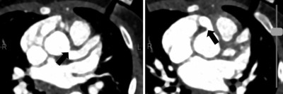 Aneurysma bei 2-monatigem Säugling mit Kawasaki-Syndrom