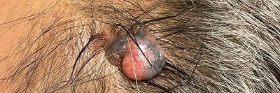 Pigmentiertes Trichoblastom auf Kopfhaut