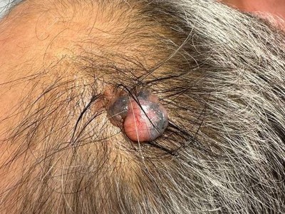 Pigmentiertes Trichoblastom auf Kopfhaut