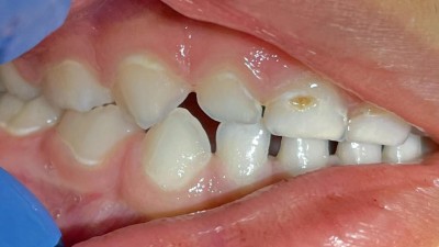 Demineralisierungen an den Zahnhalsrändern und aktive Karies am Zahn 51