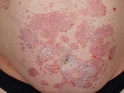 Psoriasis bei einer übergewichtigen Person am Bauch