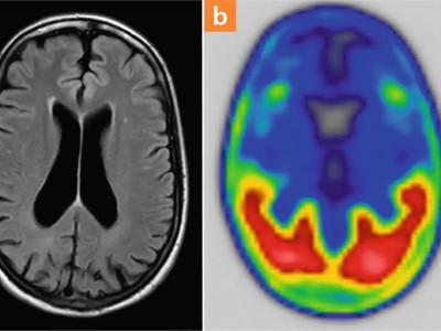 posterioren kortikalen Atrophie infolge einer Alzheimerkrankheit