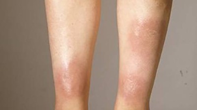 Erythema nodosum