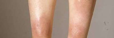 Erythema nodosum